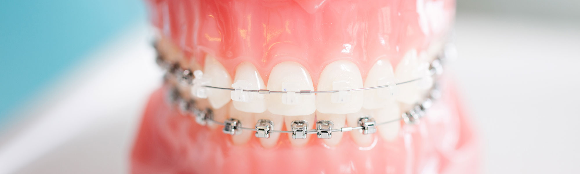 Flossing with Braces: 5 Benefits of Taking the Time to Floss Every Day