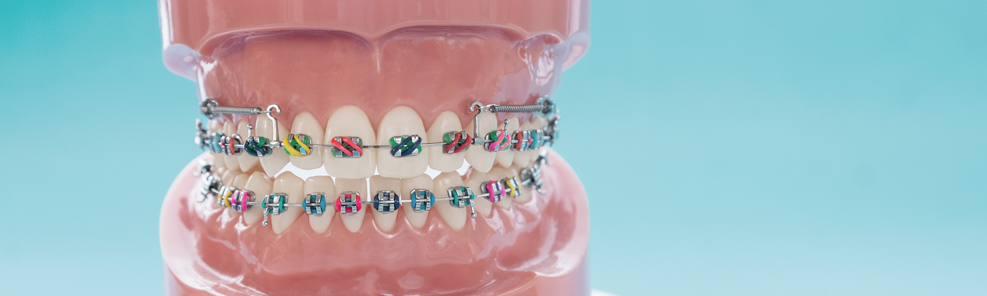 Navigating the Holidays with Braces