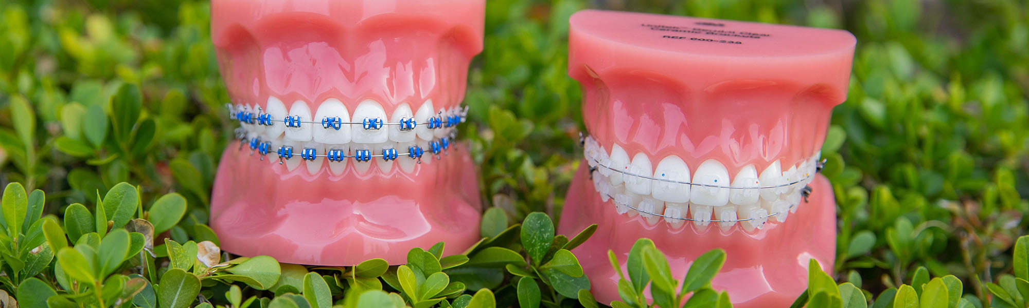 What type of Braces Are Right for Me Blog Image