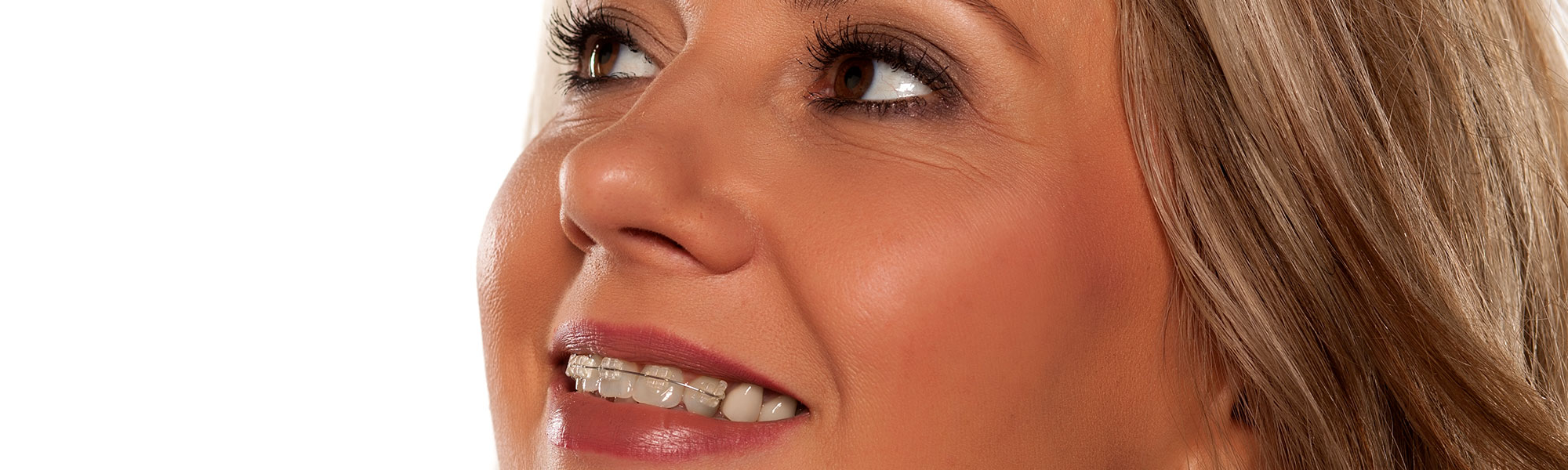 Ceramic Braces Carson CA